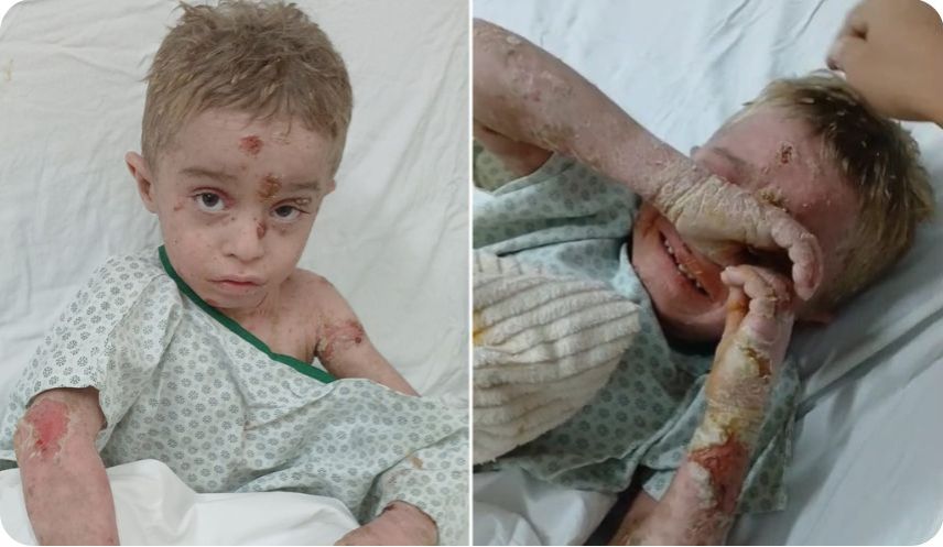 💙 Vaquinha para o Davi, que sofre com doença rara que deixa a pele em carne viva e precisa de tratamento para o resto da vida